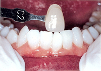 Teeth Whitening Gresham