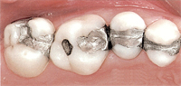 Tooth-Colored Fillings Gresham